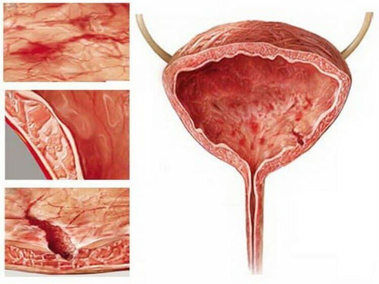 Cystonette is effectief voor alle soorten cystitis