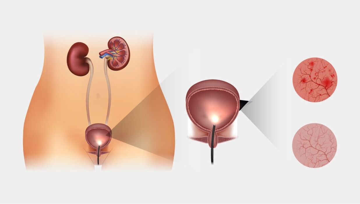 acute en chronische cystitis